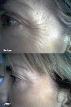 Results after Mei Zen Cosmetic Acupuncture system