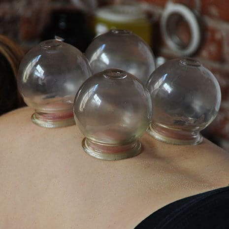 cupping session on back