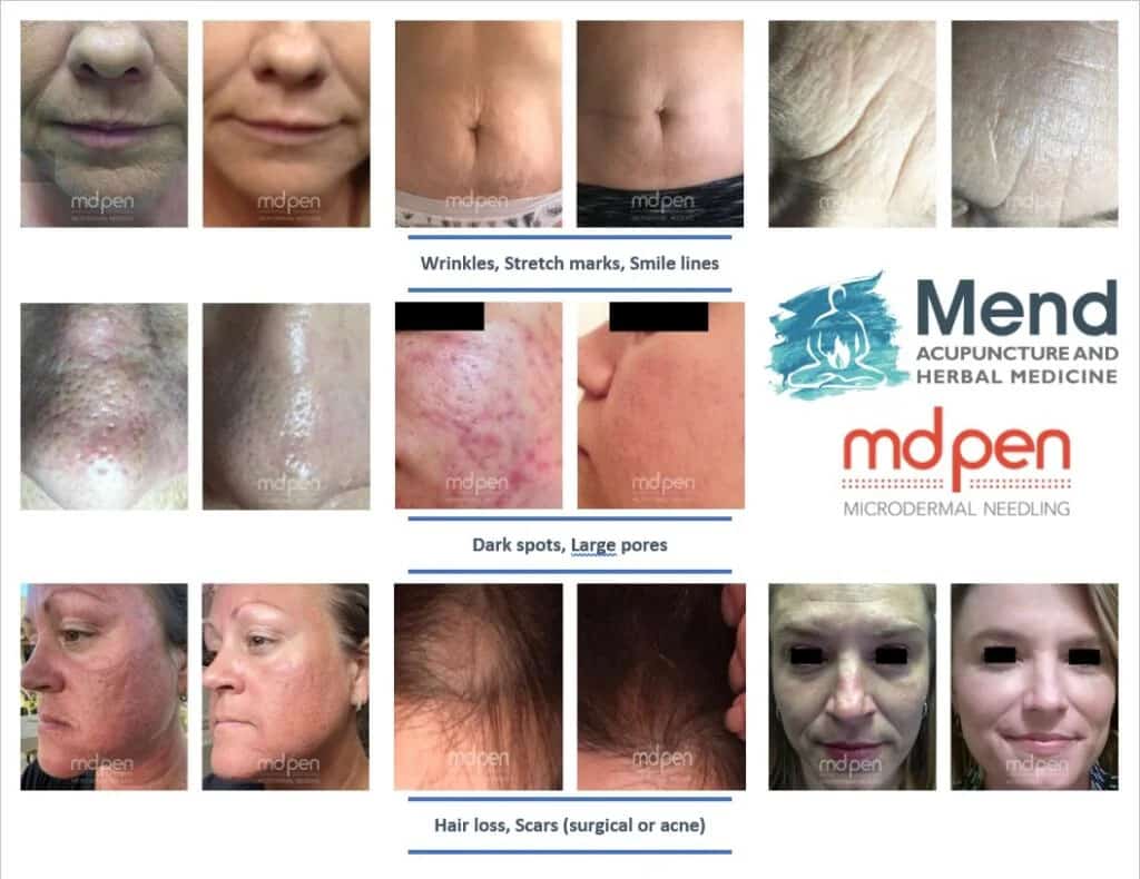 Before and After results of microneedling at Mend